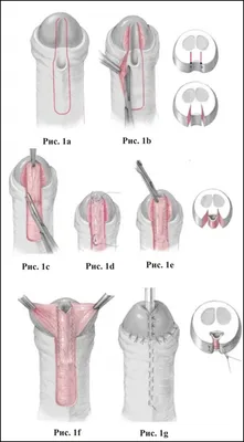 Дистальная гипоспадия (степень IIа): адаптированный метод Mathieu с  формированием уретры с устьем вертикальной формы (техника операции)