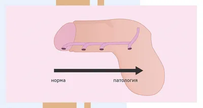 Гипоспадия: что это, симптомы, причины, диагностика, лечение