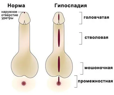 Гипоспадия - признаки, причины, симптомы, лечение и профилактика -  iDoctor.kz