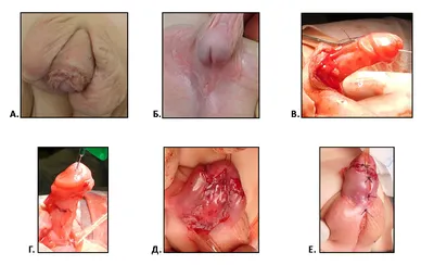 RU2738557C1 - СПОСОБ ХИРУРГИЧЕСКОГО ЛЕЧЕНИЯ ГИПОСПАДИИ - Яндекс.Патенты