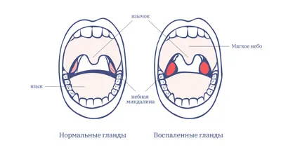 Гланды: истории из жизни, советы, новости, юмор и картинки — Все посты |  Пикабу