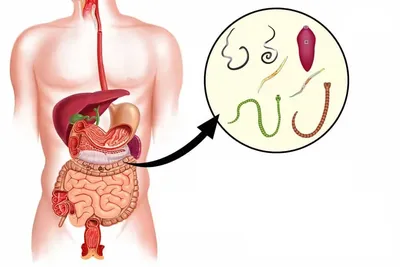 Глисты (гельминты) - добрый доктор