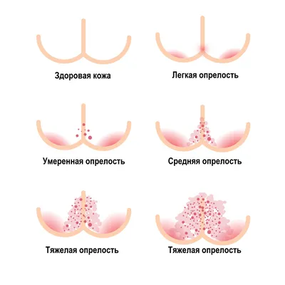 Опрелость - причины появления, при каких заболеваниях возникает,  диагностика и способы лечения