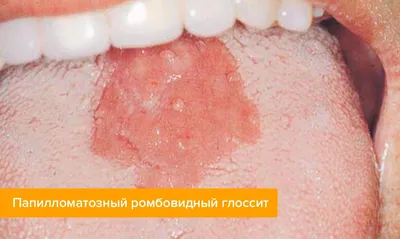 Ромбовидный глоссит — признаки, фото, лечение, уход за языком в статье  Startsmile.ru