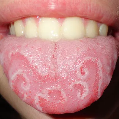 Кандидозный глоссит: симптомы, профилактика и лечение глоссита языка