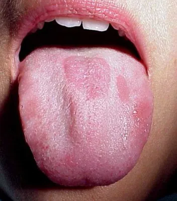 Основные симптомы воспаление языка (глоссита), виды, лечение – Стоматология  «АльфаДент» в Оренбурге
