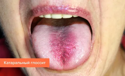 Глоссит языка — симптомы, причины и лечение