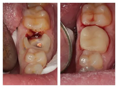 Лечение глубокого кариеса | Стоматология в Запорожье Dental Studio