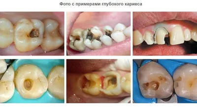 Глубокий кариес: симптомы и методы лечения зубов препаратами