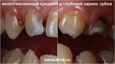 Лечение кариеса зубов » Стоматологическая клиника ЮАДЕНТ