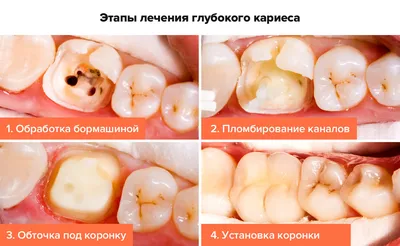 Глубокий кариес осложненый пульпитом, фото до и после Иркутск