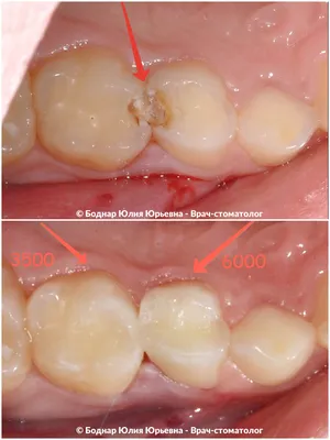 Фотографии лечения глубокого кариеса