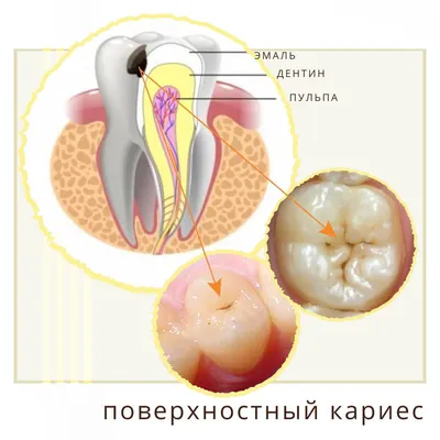 Лечение кариеса зубов в Москве | Кариес – цена лечения глубокого,  поверхностного, пришеечного