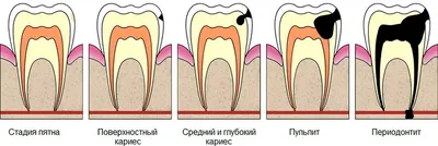 Лечение кариеса: стоимость, виды, симптомы | стоматология Нардент(МСК)