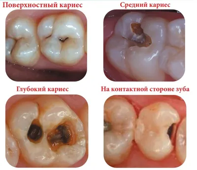 Фотографии лечения глубокого кариеса