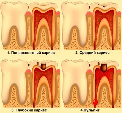 Средний кариес 47 зуба, выпадение пломбы 46 зуб | Примеры работ - фото до и  после