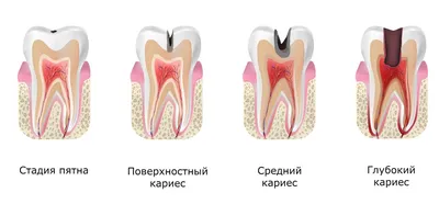 Лечение глубокого кариеса 24,25,26 зуба - Стоматология Набережные Челны -  DENTAL FORTE \"Дентал Форте\"