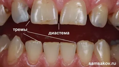 Лечение глубокого кариеса | Стоматология в Запорожье Dental Studio