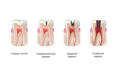 Кариес у детей (лечение в Киеве, цены) - фото, причины