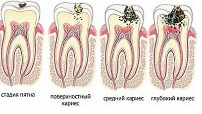 Глубокий кариес и гнилые зубы для виниров - не проблема! Как ее решить