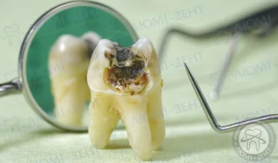Гнилой Зуб Больной 9 Фото Как Лечить ЛюмиДент