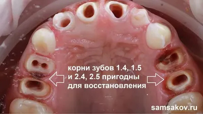 Воспаление корня зуба: симптомы, лечение, профилактика - полезная  информация от врачей стоматологической клиники доктора Фролова