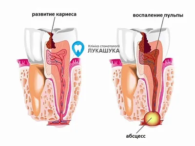 Абсцесс Зуба: Виды, Симптомы и Способы Лечения