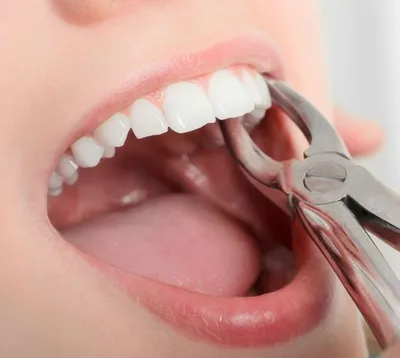 Одномоментная имплантация зубов в Новосибирске
