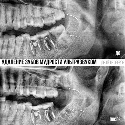 Удаление ретинированного зуба мудрости ультразвуком Piezosurgery