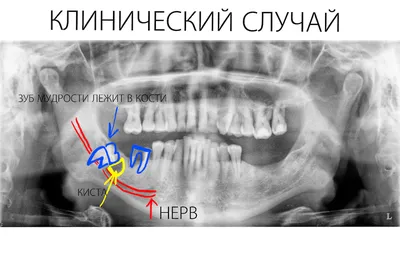 Мертвый гнилой зуб отсутствует Перейти на небо иллюстрации мультфильма Чара  Векторное изображение ©paladjai 343526580