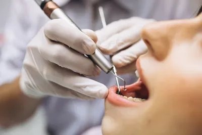 № 4 Почему в разных клиниках у Вас обнаружат разное количество зубов с  кариесом... | Пикабу