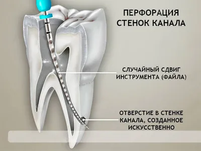 Удаление корня зуба на верхней и нижней челюсти. Цена, стоимость | НоваДент