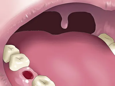 Гной после удаления зуба мудрости – почему так происходит и как лечить? |  TopDent | Дзен