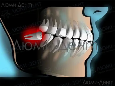 Альвеолит зубной лунки - причины появления, симптомы заболевания,  диагностика и способы лечения