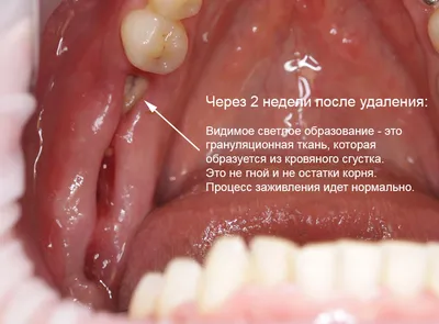 Имплантация собственных зубов. Пересадка зубов мудрости в ТОП1 клинике  Москвы – Немецкий имплантологический центр