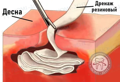 Гнойник (прыщ, абсцесс зуба) на десне – что делать, лечение нарыва на десне