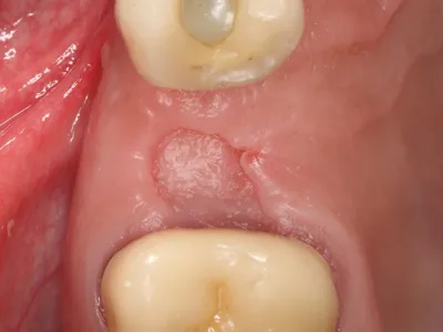 Альвеолит после удаления зуба: фото, лечение, сухая лунка | Dental Art