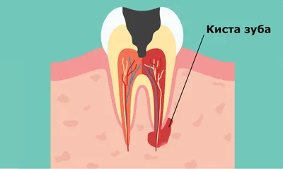 Удаление ретинированного зуба мудрости ультразвуком Piezosurgery