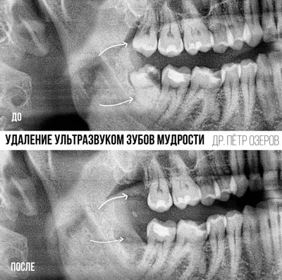 Шишка на десне после удаления зуба - Стоматология Северное Бутово Делия  только качественные услуги