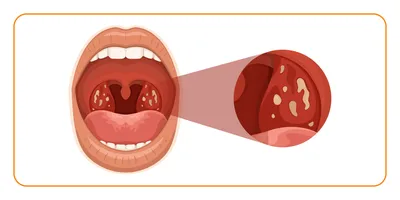 Гнойная ангина, чем лечить гнойную ангину, симптомы и признаки - блог  Furasol®