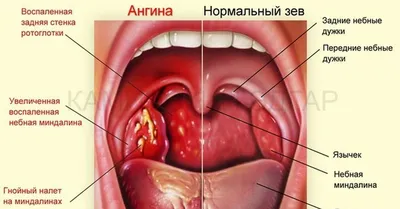 Ангина: гнойная, фолликулярная, фото, симптомы, лечение