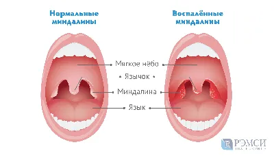 Гнойная ангина фото