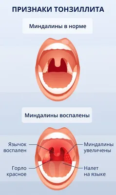 Препараты от ангины: обзор лекарственных препаратов при тонзиллите