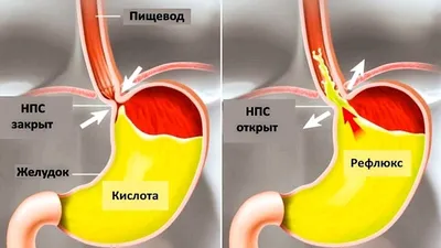 Глоссит — воспаление языка Причины, Лечение, Профилактика