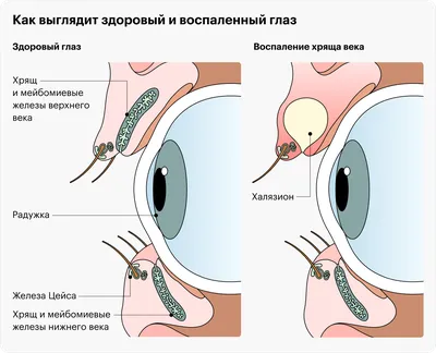 Что такое абсцесс горла, как его распознать и вылечить