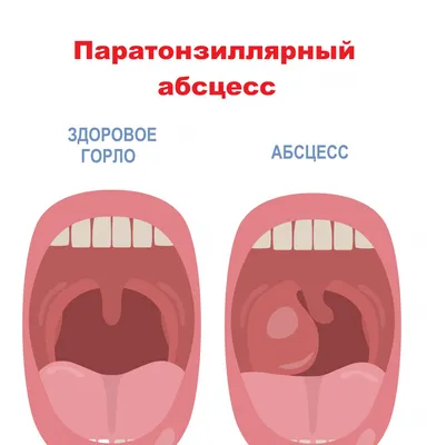 Поможем убрать пробки в горле – ЛОР-центр в Киеве | Беттертон