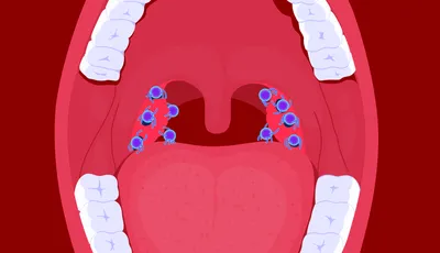 Пробки в горле: как убрать? Medicenter