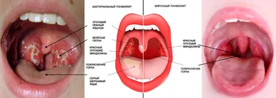 Ангина - клиника ЛОР Центр