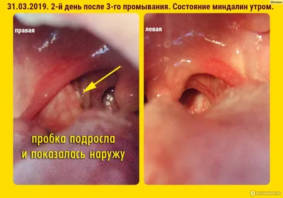 Лазерная абляция миндалин в Москве - клиника ЛОР Центр