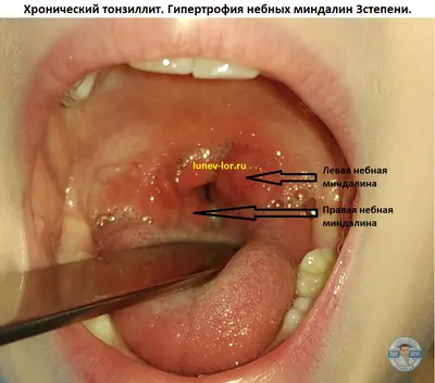 Хронический тонзиллит - ЛОР в Самаре - врач Лунёв Андрей Владимирович